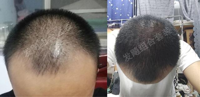 治愈脫發(fā)最新重大突破，重塑自信，希望之光再現(xiàn)