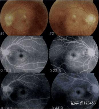 最新藥肺炎詳解，你需要知道的一切——健康小紅書(shū)